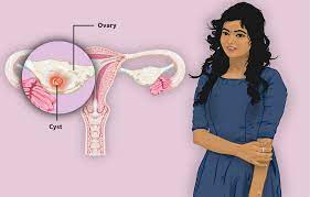 How To Shrink Ovarian Cysts Naturally?